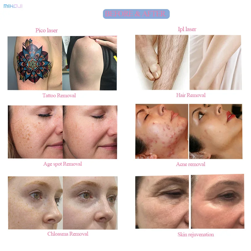 diode pico 2 in 1 laser ipl filter 590nm ipl laser hair removal machine