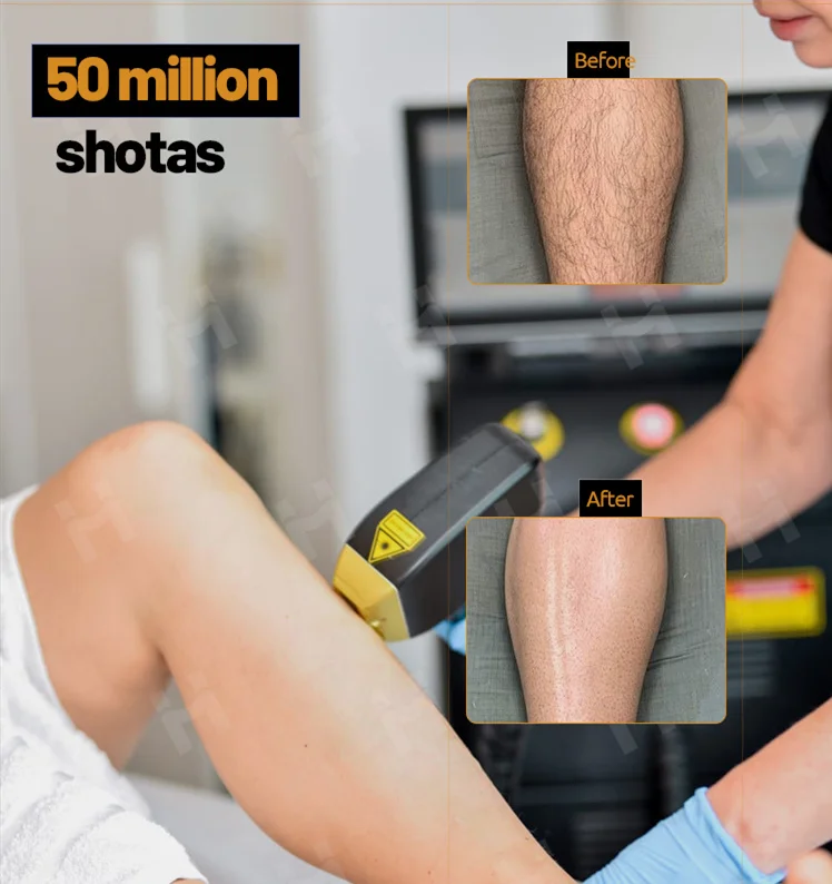 2024 Weifang beauty Device Ice platinum titanium triple wavelength adjustable heads 808nm diode laser hair removal machine