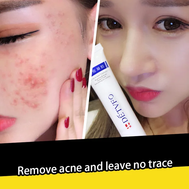 Stubborn Acne Spot Treatment Gel Pimple Cream for Acne Prone Skin with Natural Aloe vera control oil Acne repair purifying gel