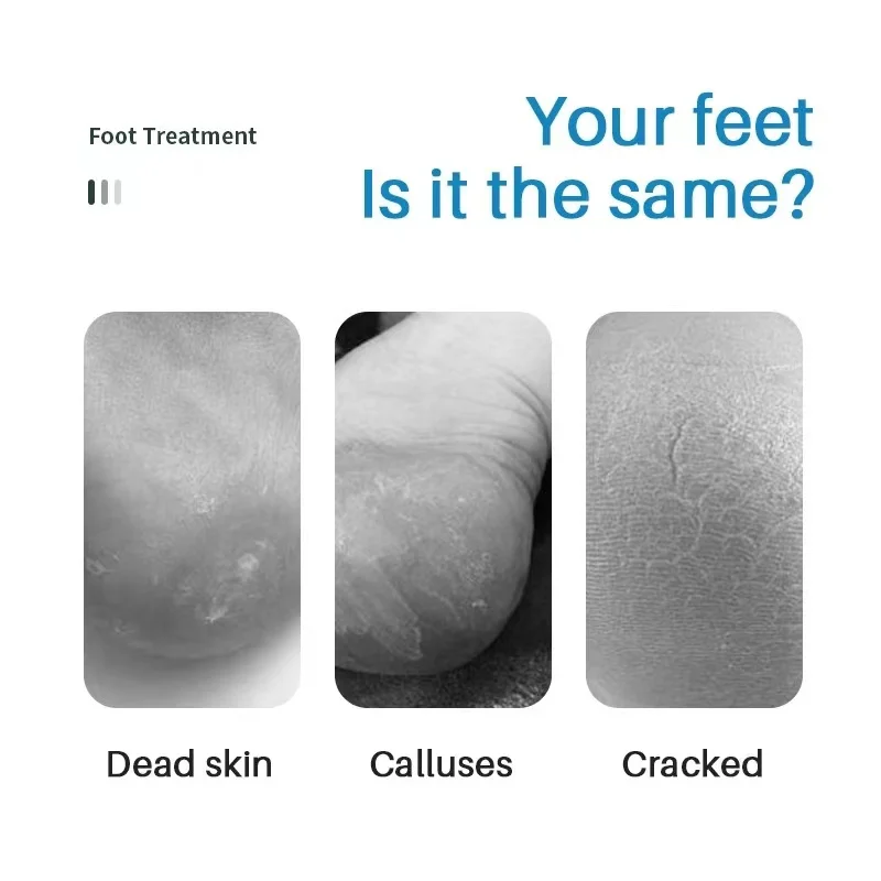 Wholesale Foot Skin Care Heels Deodorant Urea 40% Orgainc Ingredient Exfoliating Nourishing Moisturizing Peeling Foot Spray 50ML