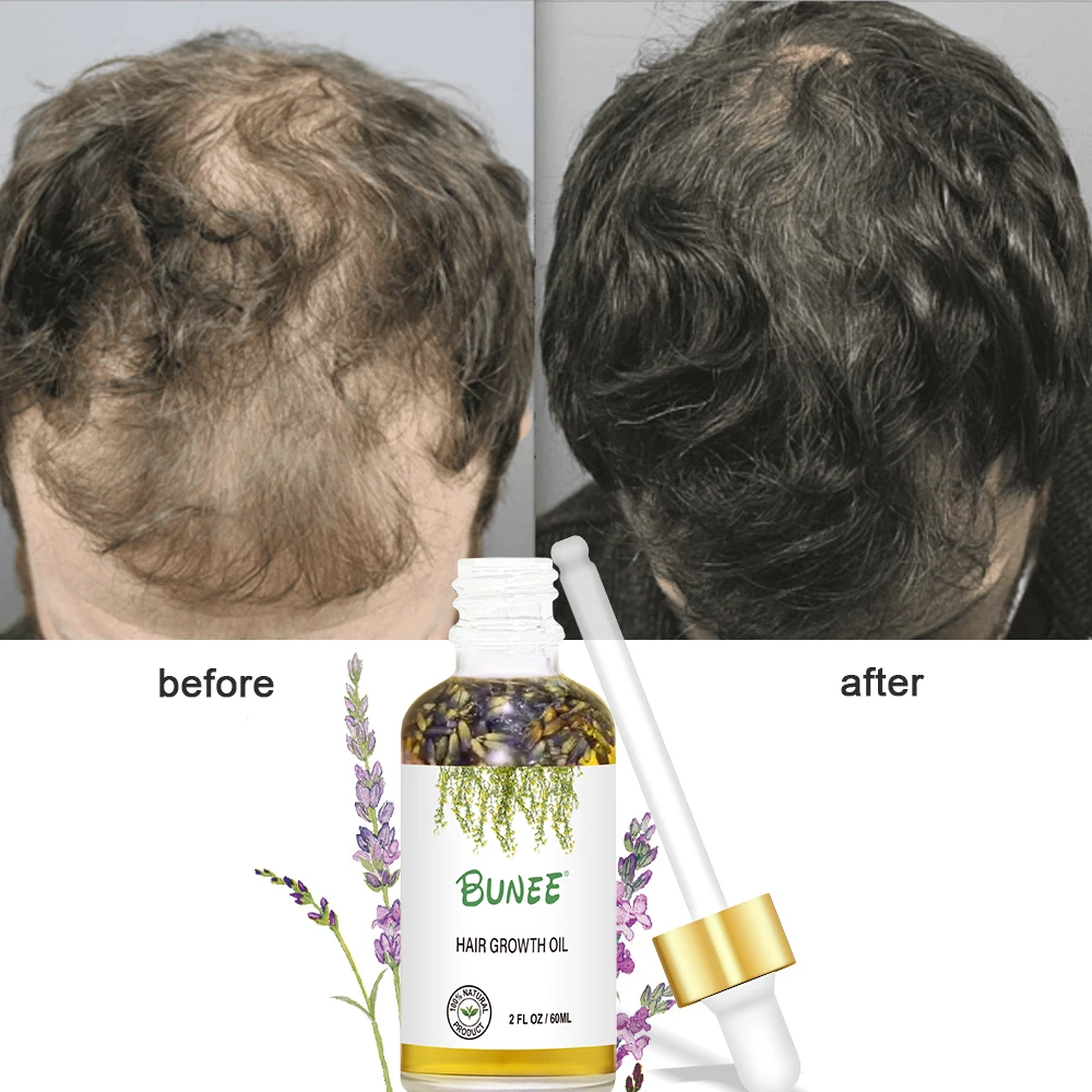 Build Your Own Label Organic Hair Regrowth Treatment Regrowth Serum Anti Hair Loss Lavender Hair Growth Oil