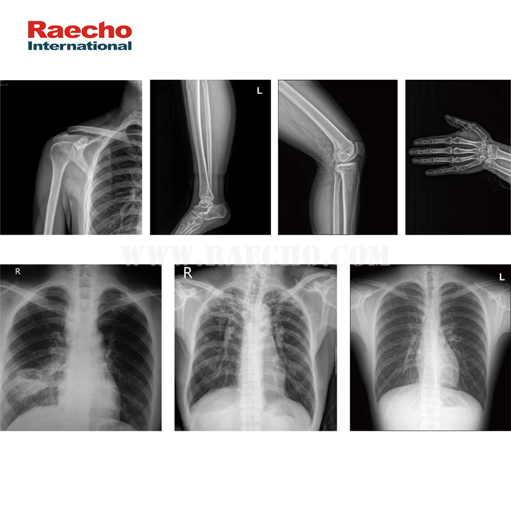 Лидер продаж, мобильная рентгеновская система, цифровая