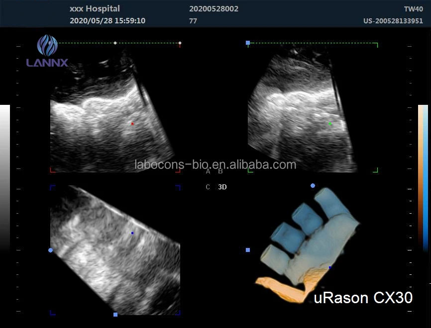 LANNX uRason CX30 Factory Quality Pregnancy use PW/CFM ultrasound Portable color doppler ultrasonido scanner ultrasound system