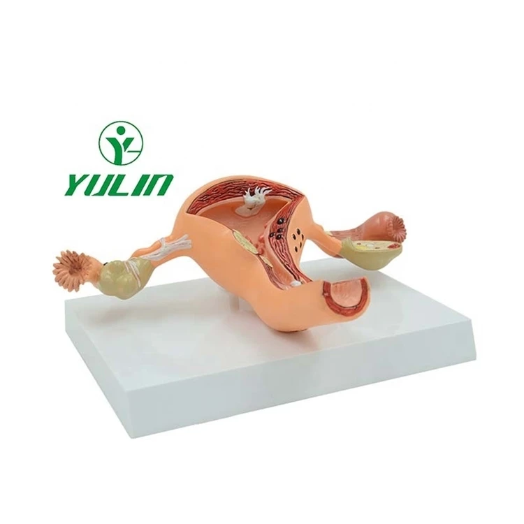 Factory Educational equipment female human anatomy uterine lesion model PVC anatomical model