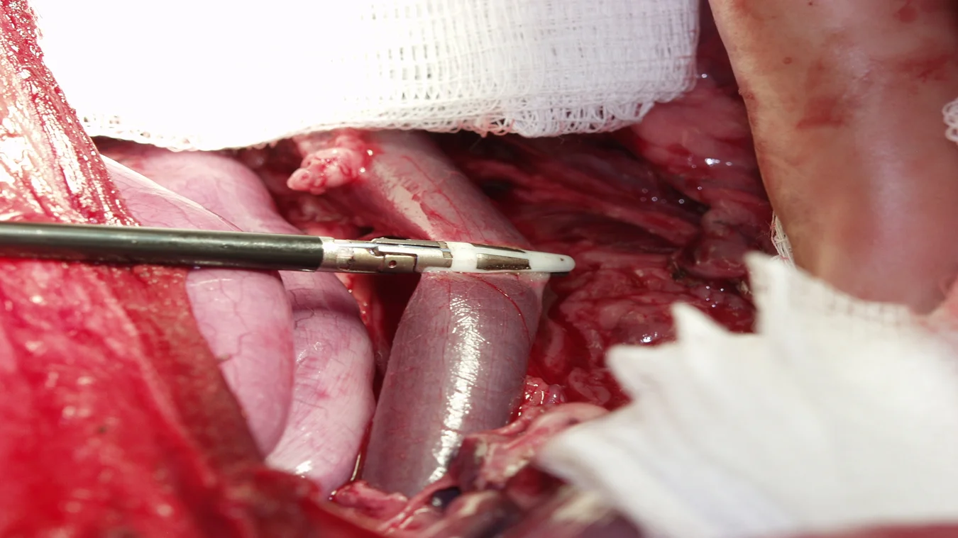 vessel ligation ligasure.png