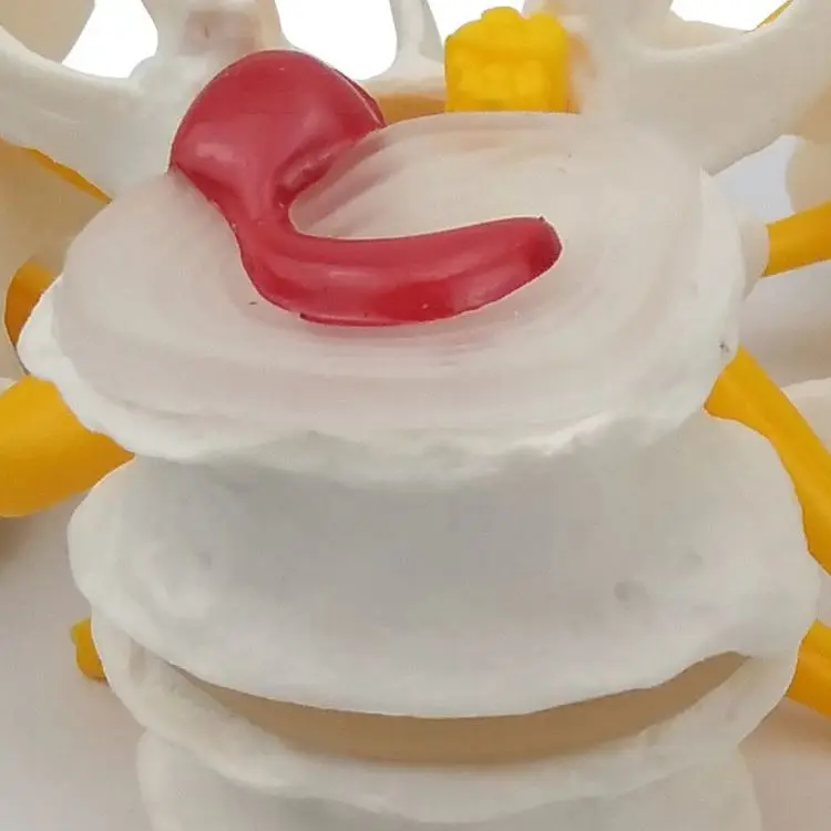 
The diseased model of vertebrae 