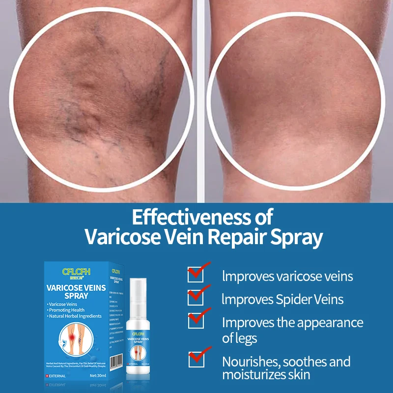 Varicose Vein Spray Spider Varicose Veins Relief cream Herbal Ointment 30ml