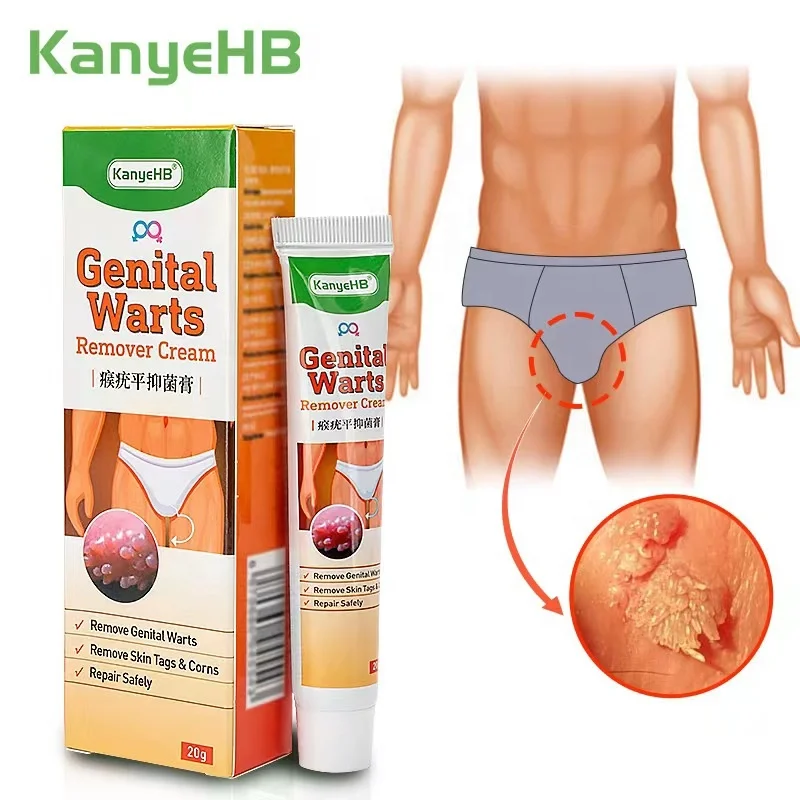KanyeHB Ointment Genital wart treatment Herpes Genital Vulva Condyloma Acuminatum Skin Tag genital wart removal cream