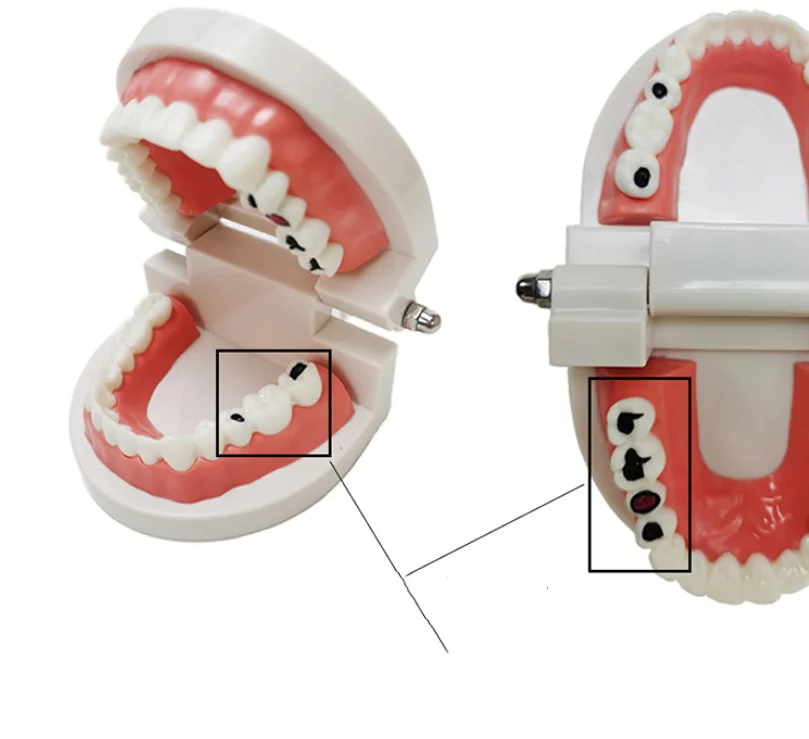 Заводской стандарт патологии для взрослых стоматологическая обучающая модель с кариесами