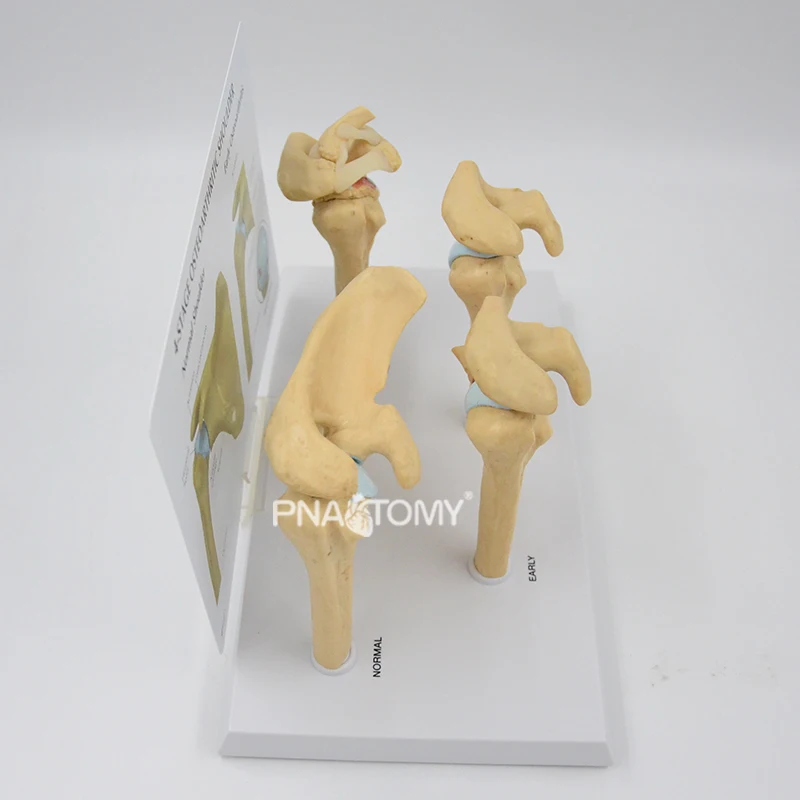 4-STAGE OSTEOARTHRITIS (OA) SHOULDER ANATOMY MODEL HUMAN SKELETON ANATOMICAL MODEL TEACHING RESOURCES EDUCATIONAL EQUIPMENT