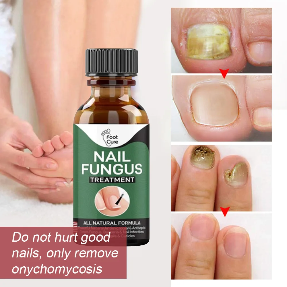 Nail Fungus treatment 10ml foot cure