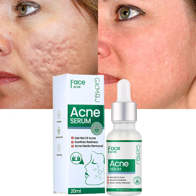 microbial fermentation skin care,sensitive skin acne itch swelling soothing removal,private label anti acne whitening face serum