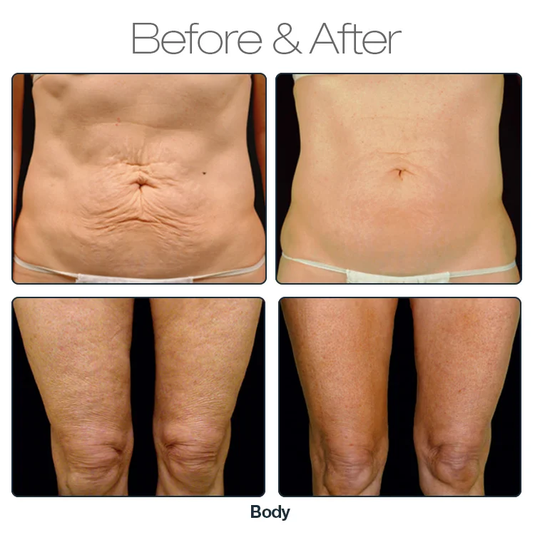 Need-free fractional radio frequency machine for eye face and body 5mhz RF for facial skin tightening eye wrinkle removal