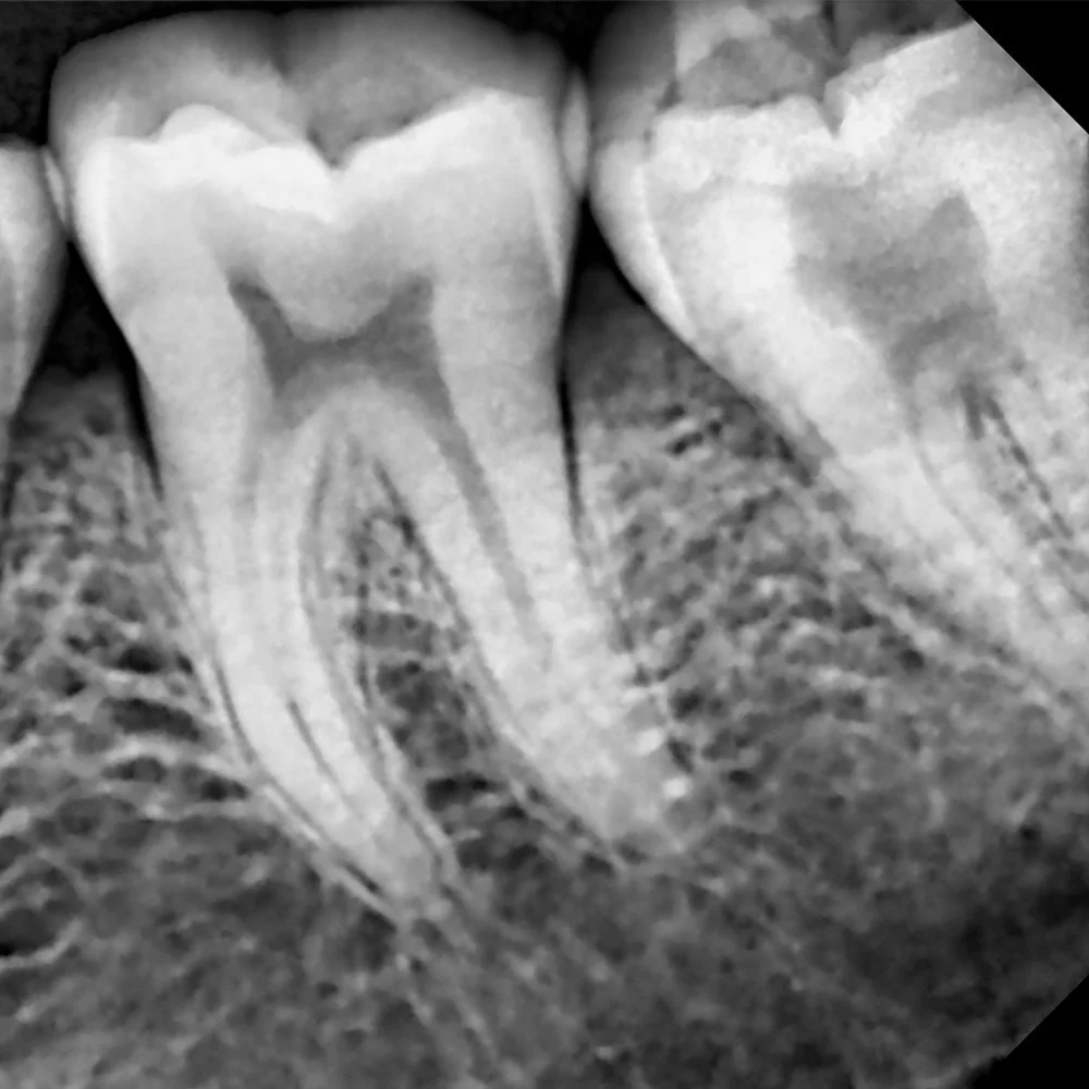 65kV 2mA High Frequency Dental Portable X-ray Machine Unit with Digital RVG Sensor