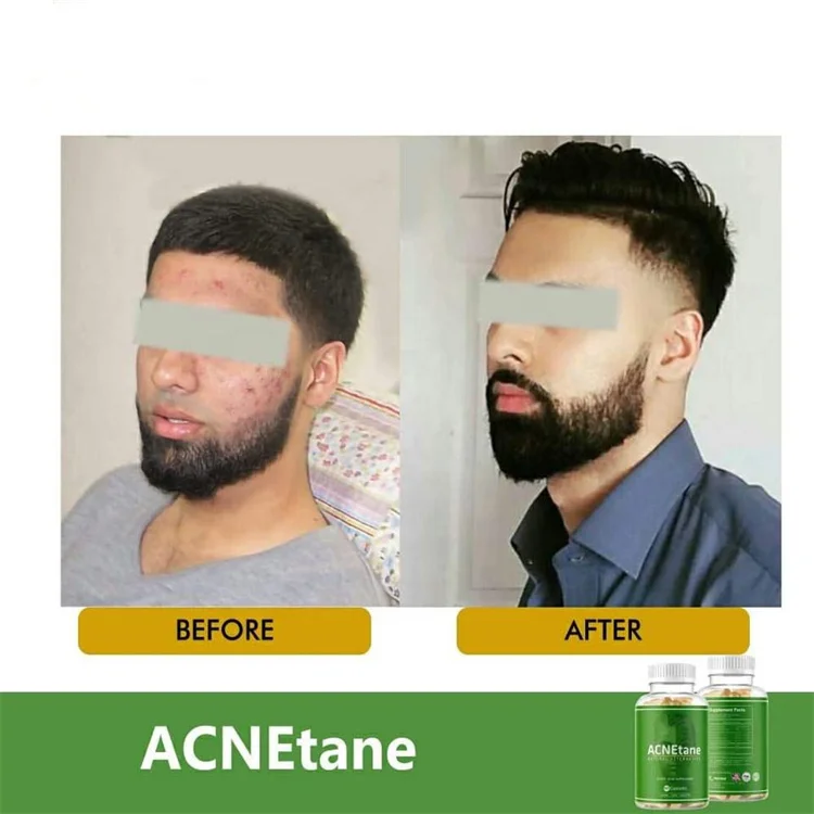 Customized Hormonal Skin Acne Vitamins and Supplements skin care gummies