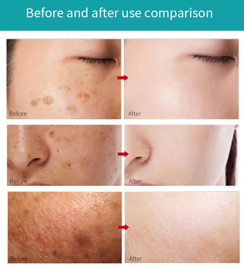 Oem Private Label White Gold Skin Whitening Face Dark Spot Corrector Anti Freckle And Freckle-Removing Cream