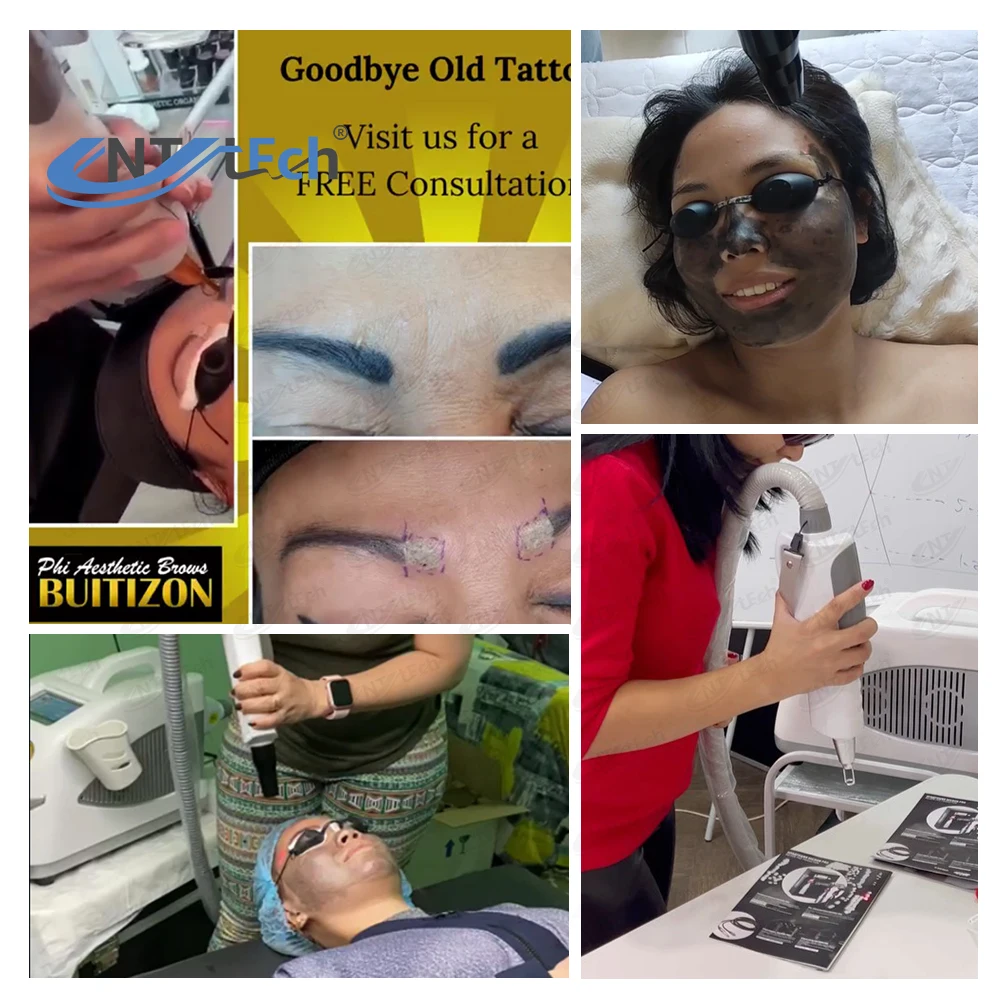 Professional manufacturer laser q switch nd yag laser tattoo removal device