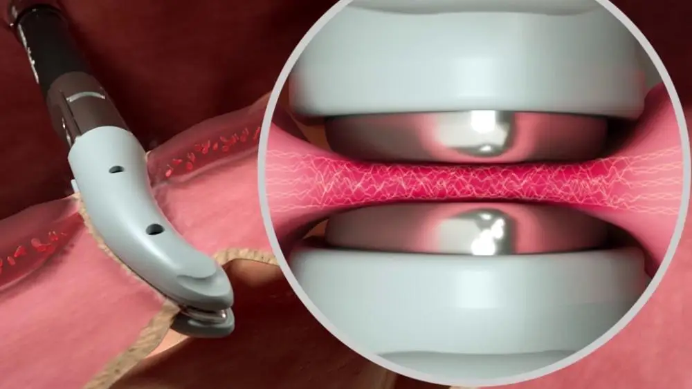 Valleylab Ligasure Instrument for laparoscopy surgery