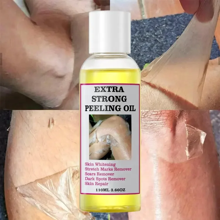 Yellow Peeling Oil Skin Whitening Stretch Marks Removers Scar Remover Dark Spot Remover Strong Green Yellow Peeling Oil