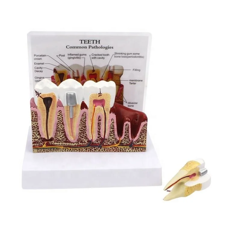 
Dental study model plastic periodontal teeth human medical decay teeth removable model 