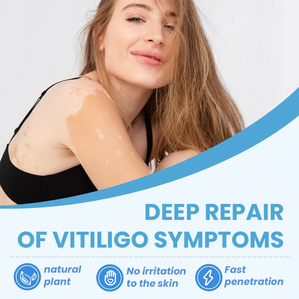 Sumifun Wholesale 30ml Vitiligo Treatment Remover Spray White Spot Skin Care Spray
