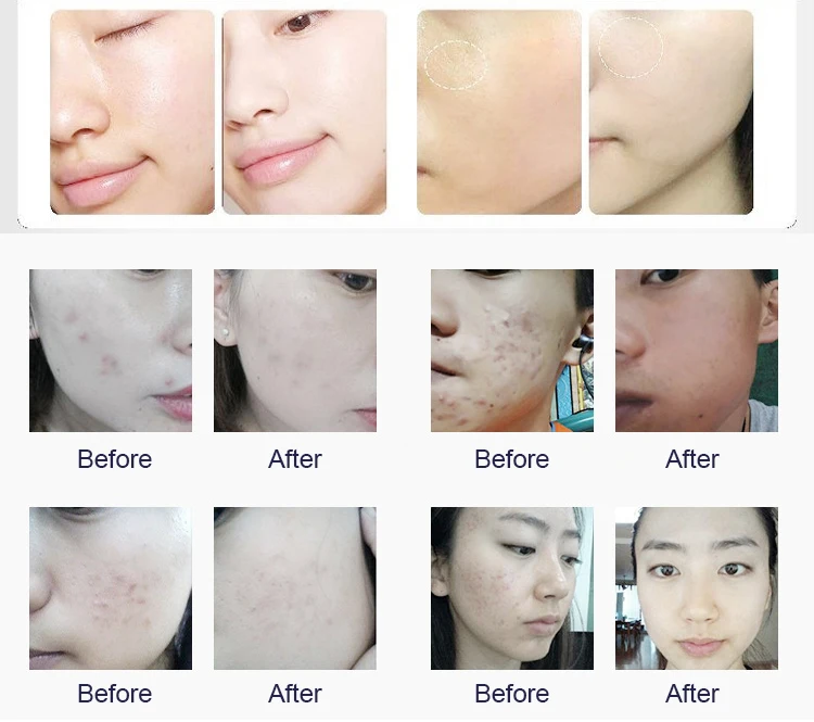 Professional Design 360 Oxygen Bubble Meter Microdermabrasion Aqua Peel Facial Machine With Eliminates Redness And Sensitivity