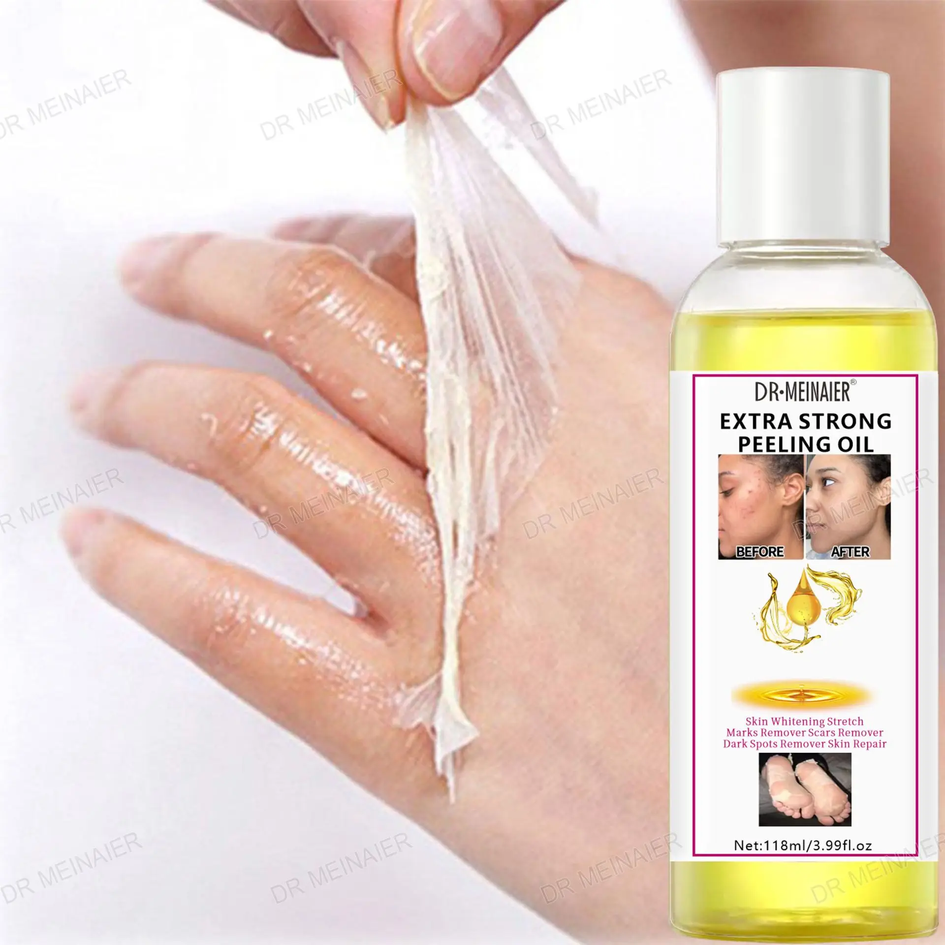 Extra Strong Yellow Peeling Oil for Exfoliating Dark Skin on Elbows, Knees, and Fingers