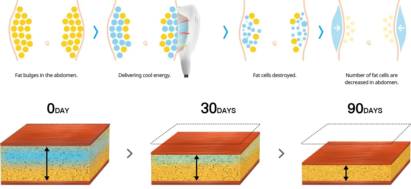 360 Cold Cellulite Cryotherapy Lose Weight Slimming Machine 360 Cryolipolysis  Device