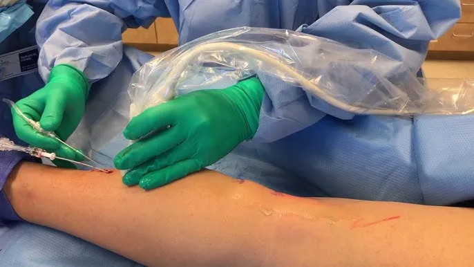 2024 Dual-Wavelength Operation 980nm & 1470nm Shaping Health Blood Vessels EVLT Varicose Veins Treatment doctor use device