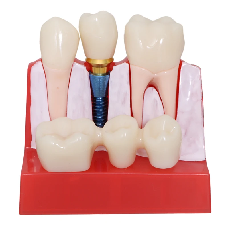 Dental teaching model 4 Times Dental Model Teeth Implant Model For Doctor-Patient Communication