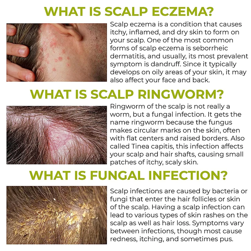 Relieve Itchy Dry Scalp and Treat Dandruff Seborrheic Dermatitis Psoriasis with Anti-Folliculitis Hair Growth Shampoo