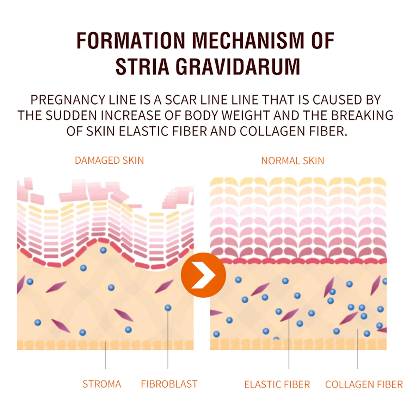 Hot Sale 100% Safe Natural Vegan Anti Postpartum Vergeture Marks Removal Repairing Scar Stretch Mark Spray