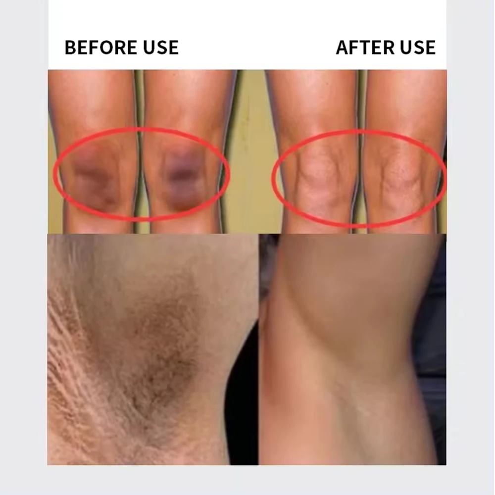 Pimples Melasma Blemish Removal Dark Spot Remover Cream Strong Bleaching Whitening Face Freckles Remove Corrector Cream