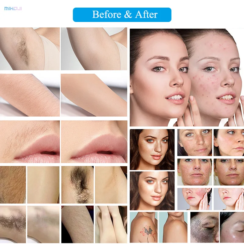 alex andrite pro 755 1064 808 diode laser hair removal machine alex andrite laser hair removal machine price