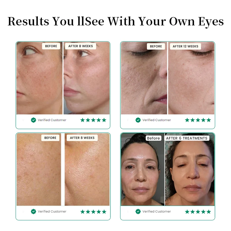 Smoothing Brightening Hyaluronic Acid Mesotherapy Ampoule Serum Micro Infusion Serum Microneedling Stamp Serum