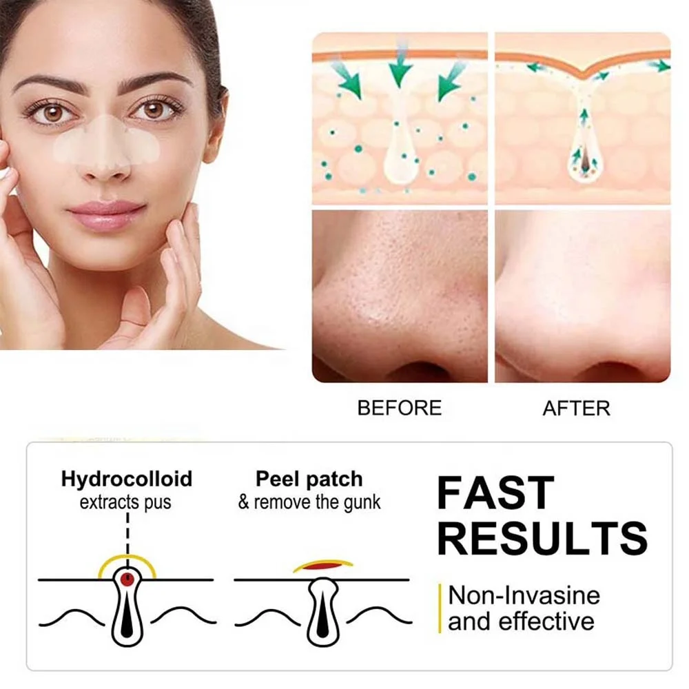 Quality Approved Overnight Pore Strips Hydrocollid Nose Patch for Nose Pores, Pimples, Zits and Oil to Absorb Acne Nose Gunk