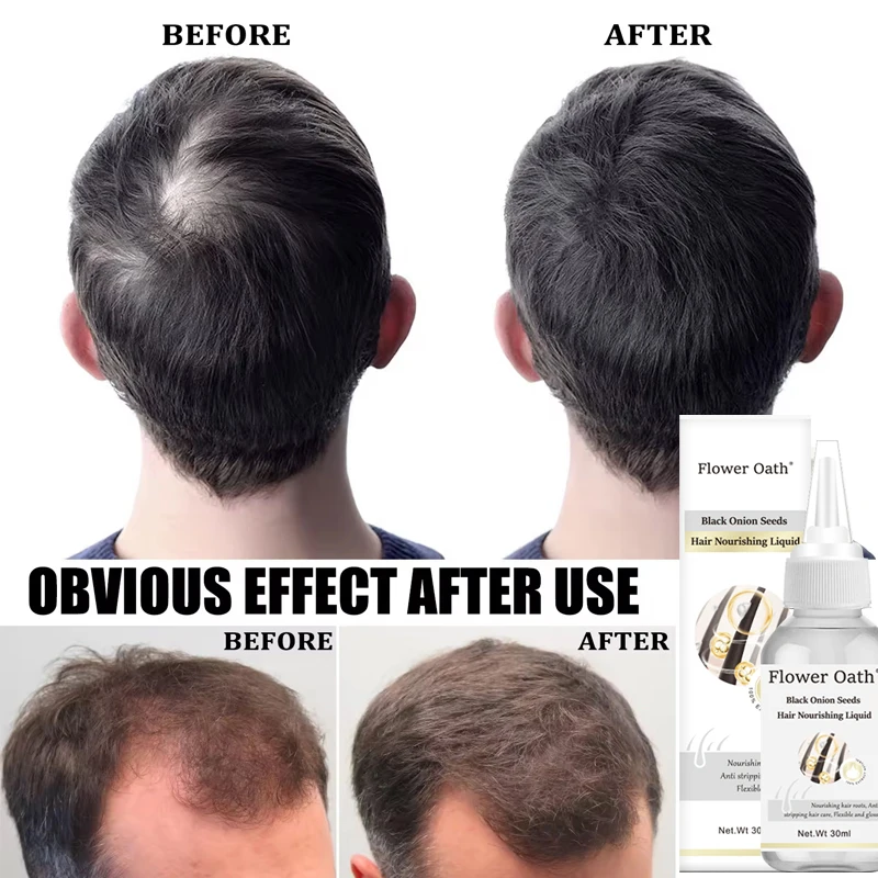Flower Oath onion rosemary black seed extract hair growth hair loss preventing oily hair scalp treatment liquid Growth Serum