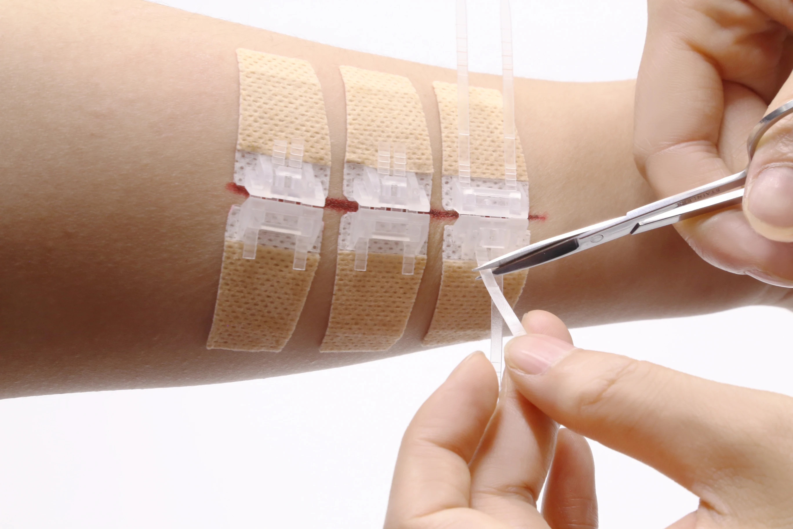 medical wound closure device non-invasive suture skin surface stapler zip stitch