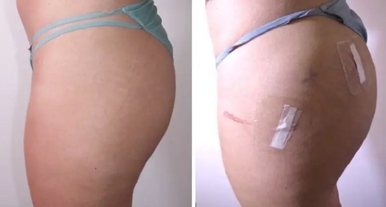 Wholesales Price 24mg/ML Ha Dermal Filler Injection Cross-Linked Hyaluronic Acid Korea Dermal Filler