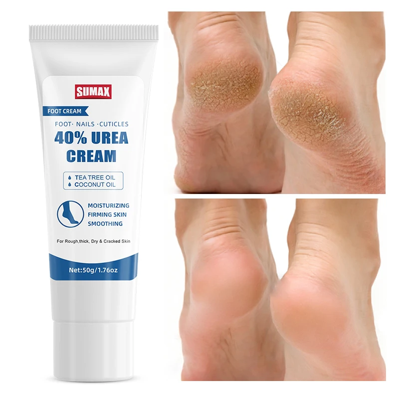 Sumax Wholesale 40% Urea Cream Foot Skin Care Cream For Dry Cracked Foot Heel