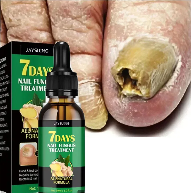 Toenail Care Solution Natural Nail Essence Fix Renew Damaged Molds Nail Broken Cracked Discolored Nails Fast Repair Serum