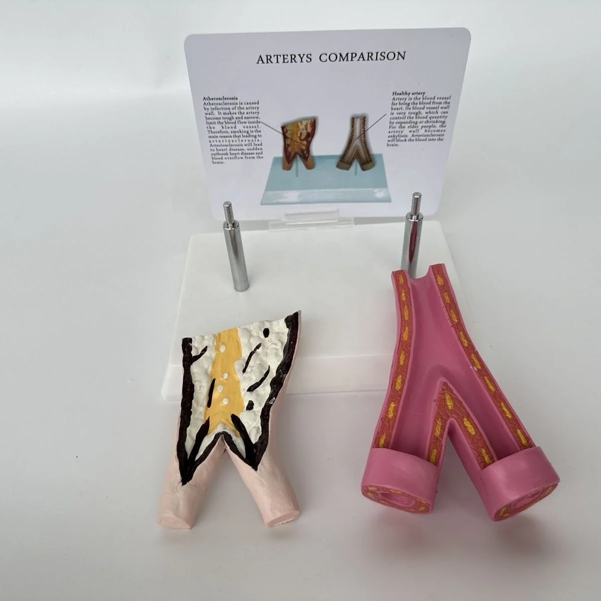 Medical Sciences Comparison Model Between Smoking Blood Vessels and Normal Blood Vessels  Artery Pathology Model