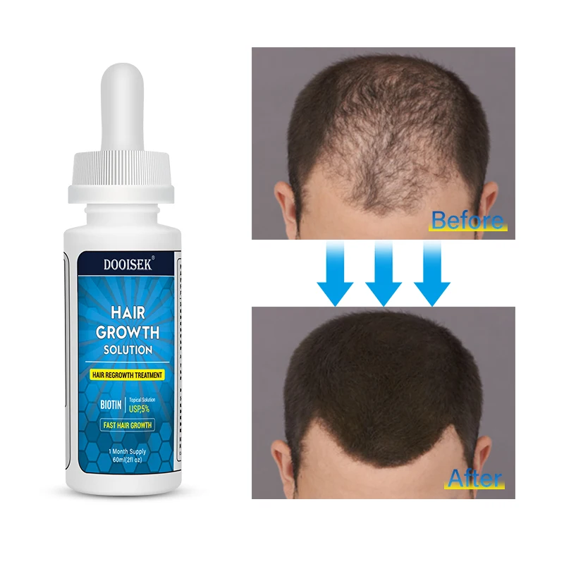 60ml Hair Growth Serum Regrowth Treatment 5% hair growth Oil agent Prevents Hair Loss Nourishing with Dropper