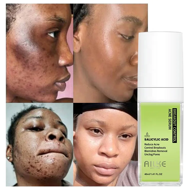 ailke wholesale best salycilic acid acne pimple face brightening anti-acne serum facial