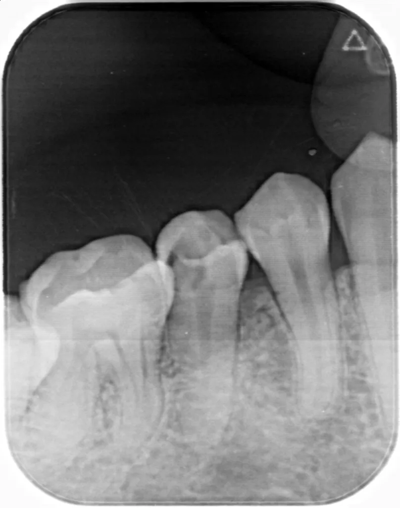 Wholesale Price Cheap Dental PSP Phosphor Plate Scanner For Imaging 2# Phosphor Plate Film Included