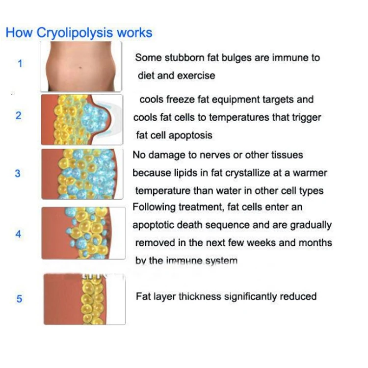 The Newly Upgraded  Radio Frequency Skin Tightening Fat Freezing Machine Slimming Shaping  Weight Loss Ultrasound Cavitation