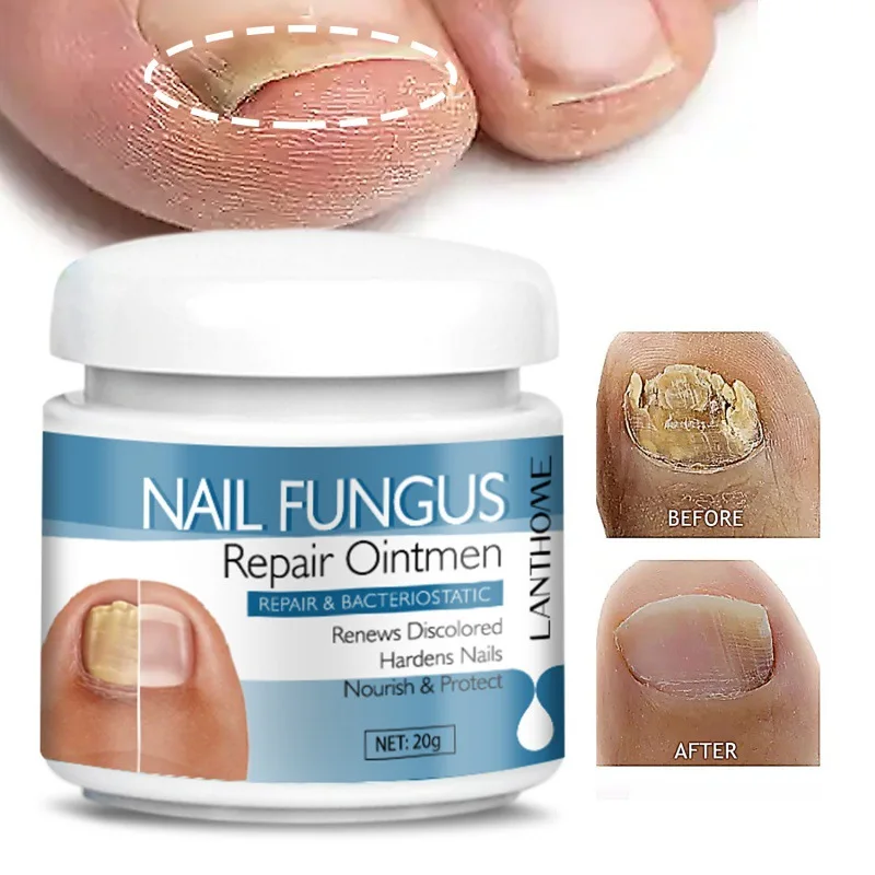 OEM Nail Onychomycosis Fungal Treatment Foot Cream Fungus Removal Cream Paronychia Anti Infection Nails Fungus Repair Ointment