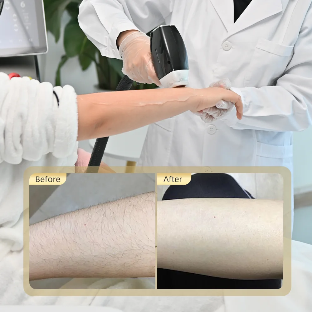 Medical CE Approved Laser Beauty Equipment 3 Wavelength 755 808 1064 Diode Laser for Hair Removal & Epilation