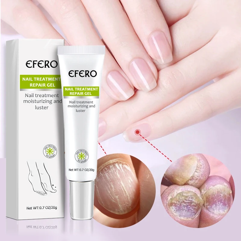 EFERO Herbal Nail Repair Cream Gel Feet Care Anti Infection Onychomycosis Fungal Nail Treatment Cream