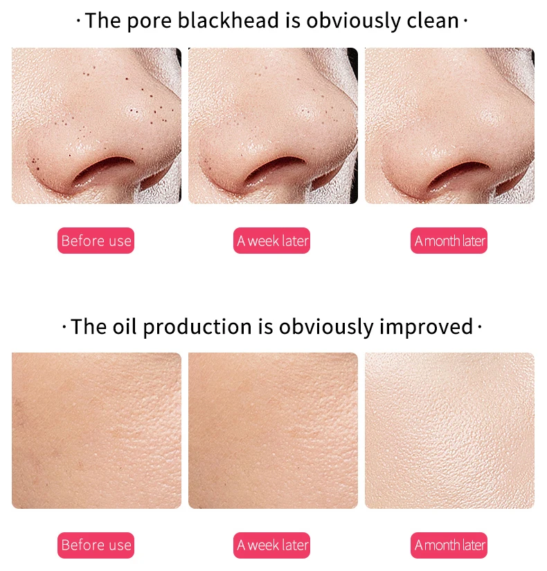 New Design Remove Blackheads Instrument Ultrasonic Sonic Blackhead Instrument